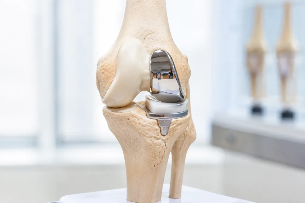 Partial Knee Replacement Surgery