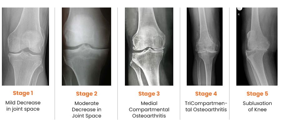 Best Total Knee Replacement Surgeon in Faridabad - Dr Deepak